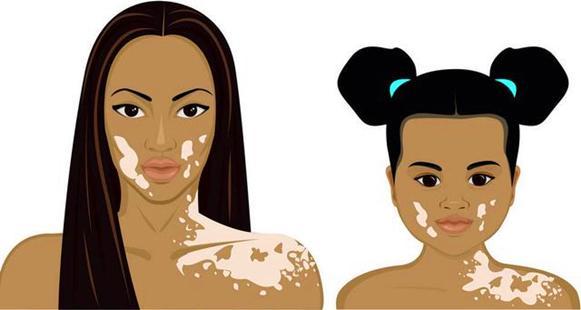 白癜风对人的危害都有什么